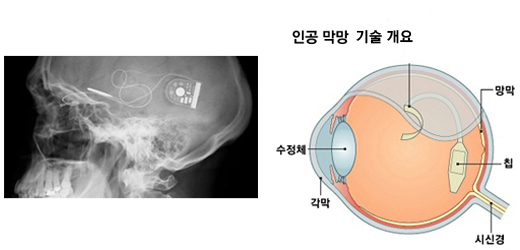 옥스퍼드 안과 병원 연구진이 뇌에 이식한 인공 망막 장치를 X선으로 촬영한 모습(왼쪽)과 인공망막 기술 개요. /BBC 제공