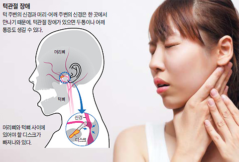 
	턱관절 장애 급증 / 출처=조선일보DB
