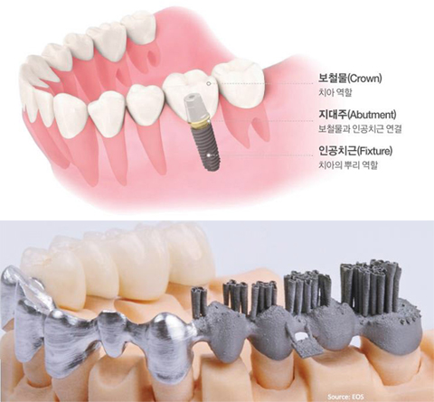 
	치아 임플란트 주요 요소 /오스템임플란트 (위 사진) 
독일 EOS 시스템즈가 3D 프린터 등으로 각종 보철물을 출력, 전시한 모습/E.O.S 홈페이지 (아래 사진)
