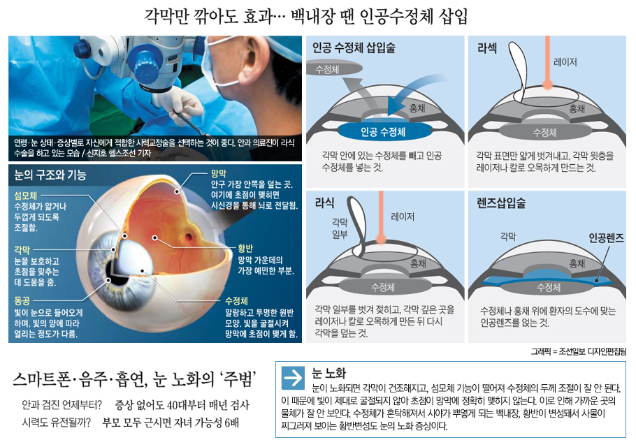 시력교정 수술, 눈 상태에 따른 적합한 방식 골라야