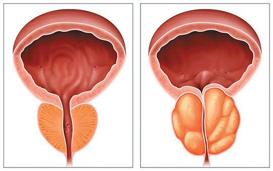 전립선비대증 개념도(왼쪽). 정상 전립선보다 커진 전립선이 요도를 막고 있다.
