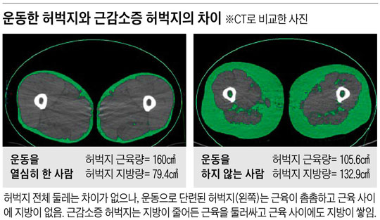 운동한 허벅지와 근감소증 허벅지의 차이.