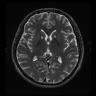치매치료를 받고 있는 뇌의 평면 MRI./조선일보DB