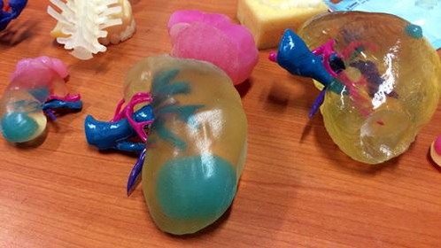 3D 프린터를 이용해 만든 신장 모형. 서울아산병원은 신장모형을 통해 혈관과 종양 위치를 정확하게 파악하고, 신장암 수술 정확도를 높였다고 밝혔다.