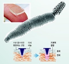 기생충 패치 접착력, 의료용 스테이플러 4배