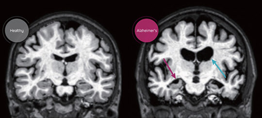 왼쪽 정상 뇌와 오른쪽 알츠하이머 치매 환자 뇌의 MRI 사진. 알츠하이머 환자는 기억을 관할하는 아래쪽 해마 부위가 위축돼 있고, 조직이 퇴화해 위쪽 뇌실이 커져 있다. 이런 소견은 전형적인 알츠하이머 치매 MRI 모습이지만, 모든환자에게 나타나는 것은 아니다. /조선일보 DB