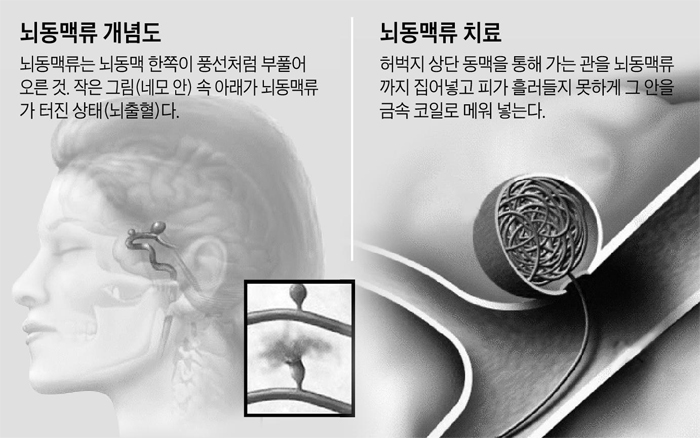 뇌동맥류 개념도