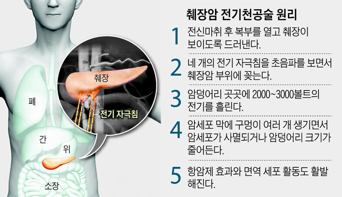 췌장암 전기천공술 원리