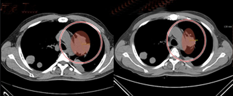 폐에 전이된 간암, 하이푸 치료 전과 후의 모습.