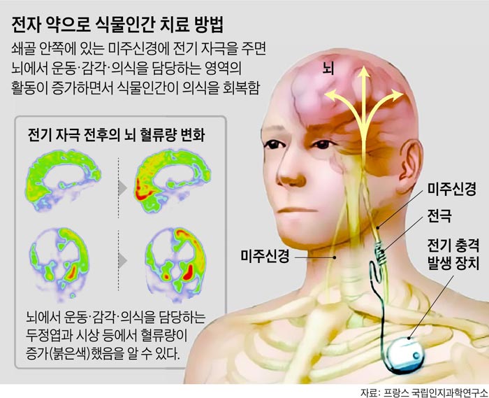 전자 약으로 식물인간 치료 방법