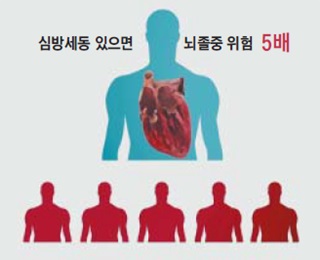 심방세동 있으면 뇌졸증 위험 5배