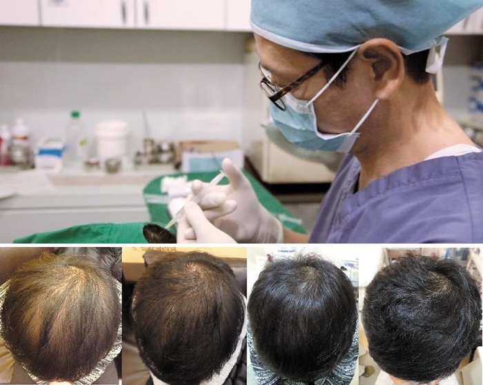 임재현 hCELL 클리어준파라메딕의원 원장이 ‘hCELL 주사 요법’으로 탈모 치료를 하고 있다(위 사진).