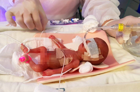 이랬던 사랑이가… - 태어난 지 이틀 된 올 1월 26일, 사랑이가 서울아산병원 신생아 중환자실에서 치료받고 있다.