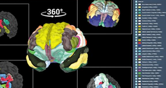 ì¹ë§¤ ì§ë¨ê¸°ê¸° âë´ë¡ìì´âë¡ ë MRI(ìê¸°ê³µëªìì) ë¨ì¸µ ì¬ì§ì 3ì°¨ì ìì²´ ììì¼ë¡ ì¬êµ¬ì±í ëª¨ìµ. ìì²´ ììì ë¶ìíë©´ ì¹ë§¤ ì§ë¨ ì íëë¥¼ ëì¼ ì ìë¤.