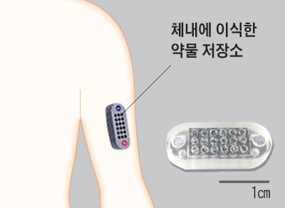 체내에 이식한 약물 저장소 그래픽