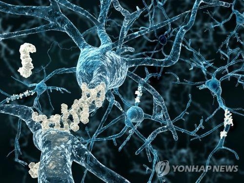 뇌 신경에 침적한 베타 아밀로이드 플라크. /연합뉴스