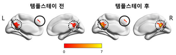 템플스테이 참가자들이 대조군에 비해 템플스테이 수행 후 디폴트모드 네트워크를 이루는 쐐기앞소엽(precuneus, 점선)과 내측상전두엽(실선) 부분 강도가 유의하게 증가했다. (붉은색에서 노란색으로 변할수록 강도 증가). /서울대병원 권준수 교수팀 제공