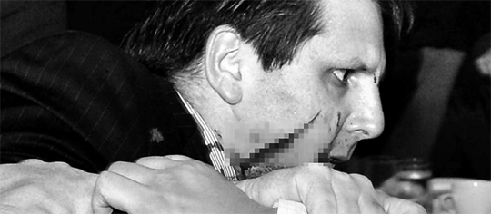 깊이 3㎝, 길이 11㎝ 刺傷 5일 오전 7시 38분 서울 종로구 세종문화회관에서 열린 조찬 강연에서 김기종씨가 휘두른 칼에 얼굴 부상을 입고 쓰러졌던 마크 리퍼트 주한 미국 대사가 주위 사람들의 도움을 받아 일어서고 있다. 리퍼트 대사의 뺨에 길이 11㎝, 깊이 3㎝의 자상이 선명하다(사진은 흑백 모자이크 처리). 리퍼트 대사는 80여 바늘을 꿰매는 수술을 받았다.