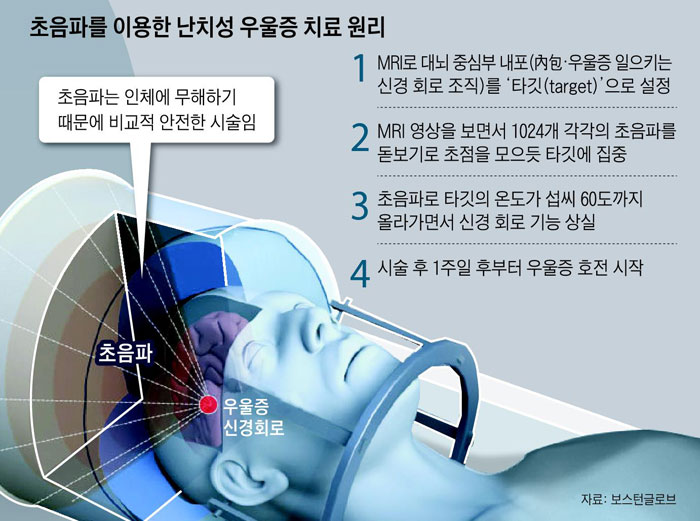 초음파를 이용한 난치성 우울증 치료 원리