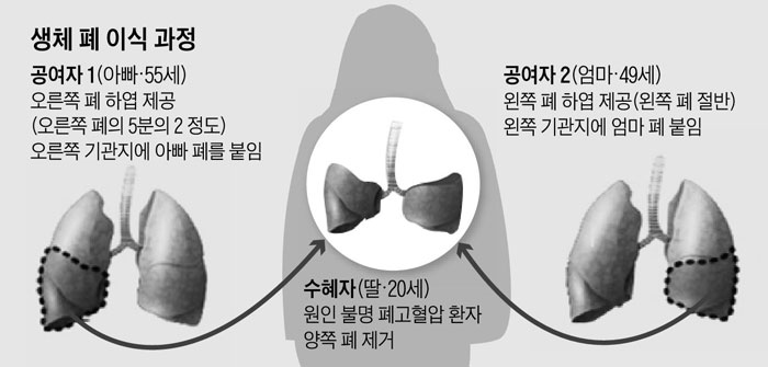 생체 폐 이식 과정