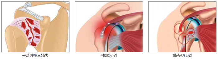 팔만 들었는데 '악!'… 어깨 3대 질환이 보내는 무서운 신호