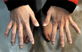 일곱 살 때부터 시작… 10년 경력의 흔적 - 굳은살이 박인 서채현의 손. 암벽 등반 10년 경력의 흔적이 손발에 고스란히 새겨졌다.