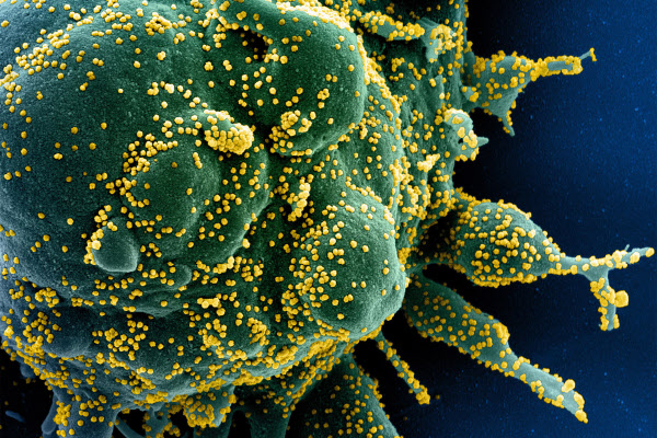 코로나 환자에서 채취한 시료를 찍은 주사전자현미경 사진. 코로나 바이러스(노란색)들이 인체 세포(녹색)에 잔뜩 달라붙어 있다./NIAID