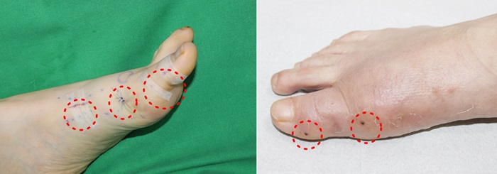 최소 침습 교정 절골술(MICA) 수술 직후(왼쪽)와 1개월 후 피부 상태. 원형 점선 부분은 수술 부위.